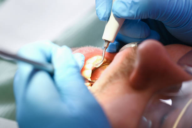Best Knocked-Out Tooth (Avulsed Tooth) Treatment in Depew, NY